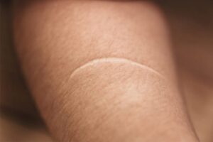keloid adalah