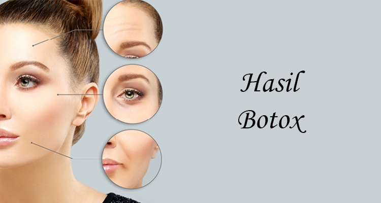 Botox Treatment : Arti, Manfaat, Dan Prosesnya - Farmanina CLinic