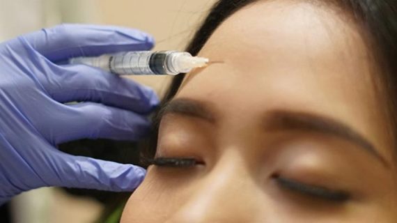 Tentang Botox, Pengertian dan Manfaatnya Yang Perlu Anda Tahu