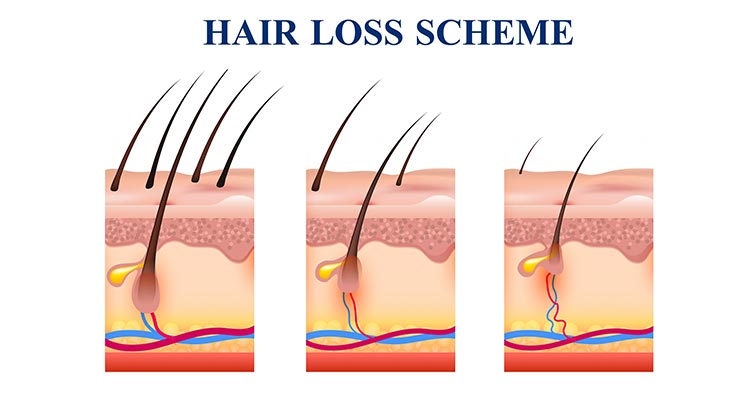 Perawatan Rambut PRP Treatment