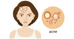 Tips Cegah Jerawat