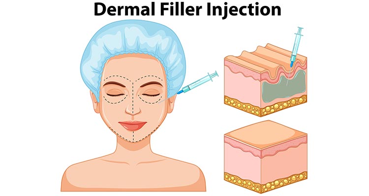 Manfaat dermal filler untuk wajah