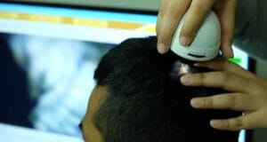 Mengenal Perawatan Rambut PRP Treatment