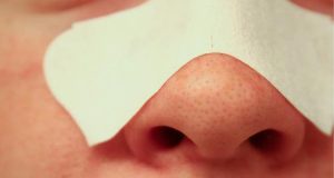 Cara Mengatasi Komedo Membandel Pada Wajah