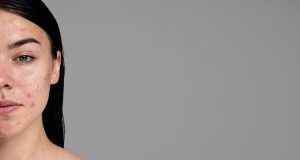 Penyebab Munculnya Jerawat Dipipi