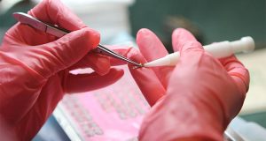 Pertimbangan Sebelum Transplantasi Rambut