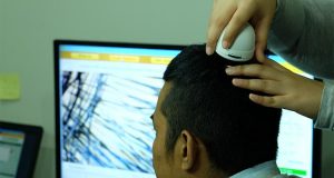 Efek Samping Transplantasi Rambut