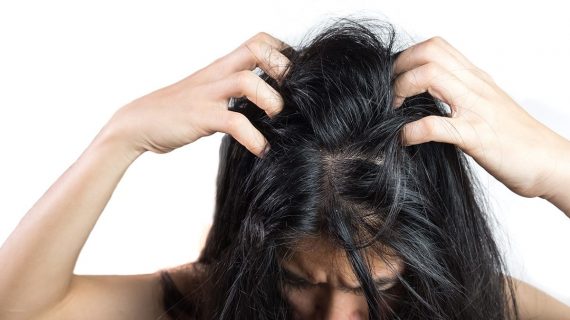 Rambut Ketombe Basah, Penyebab dan Cara Mengatasi