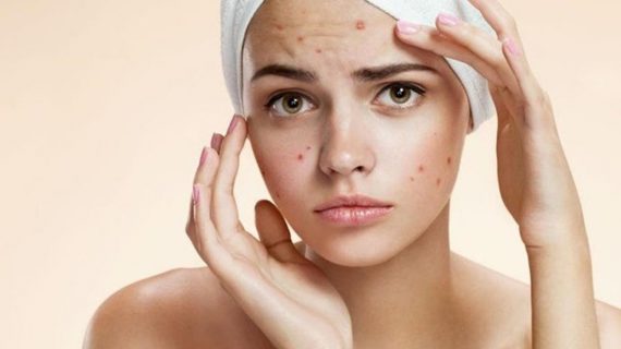 Ketahui Jenis Skincare untuk Kulit Berjerawat Terbaik