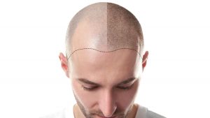 Mengenal Prosedur Transplantasi Rambut yang Banyak Dilakukan