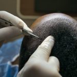 Operasi Transplantasi Rambut ini Negara yang Bisa Dikunjungi