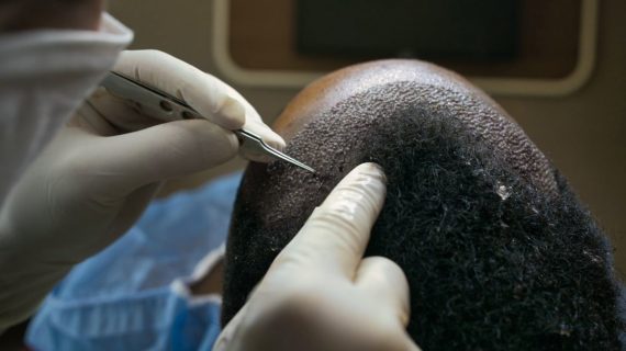 Operasi Transplantasi Rambut ini Negara yang Bisa Dikunjungi