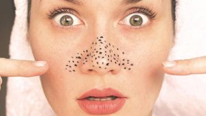 Cara Hilangkan Komedo dengan Mudah!