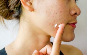 Merawat Kulit Berjerawat dengan Tepat, Hindari Keparahan