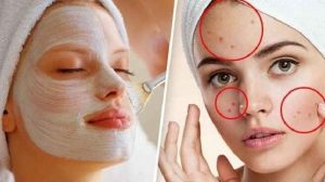 Flek diwajah Mengganggu Atasi Dengan Hal Ini!