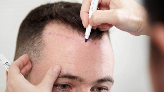 Perawatan Setelah Transplantasi Rambut yang Harus Dijalani