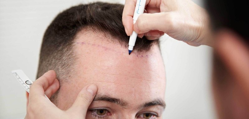 Perawatan Setelah Transplantasi Rambut yang Harus Dijalani