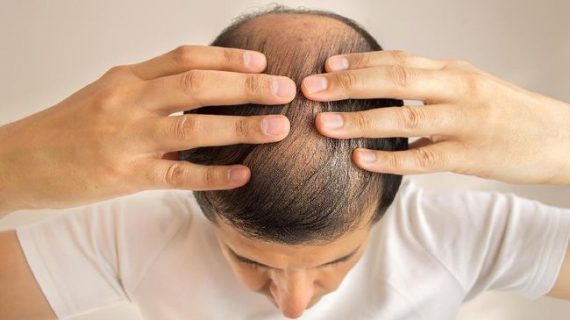 Penyebab Lakukan Transplantasi Rambut Terbaik Menjadi Pilihan