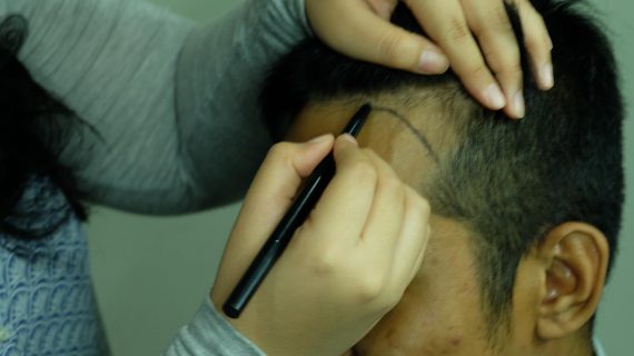 Beberapa Pertimbangan Transplantasi Rambut untuk Pertama Kali