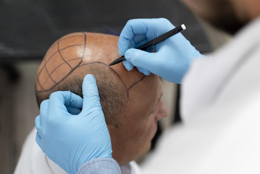 6 Fakta Transplantasi Rambut yang Wajib Diketahui