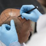 6 Fakta Transplantasi Rambut yang Wajib Diketahui