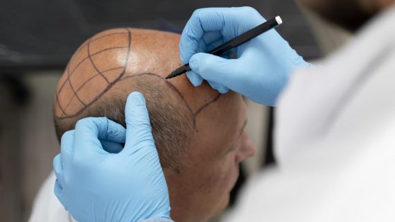 6 Fakta Transplantasi Rambut yang Wajib Diketahui