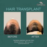 Prosedur Transplantasi Rambut dan Persiapan yang Diperlukan