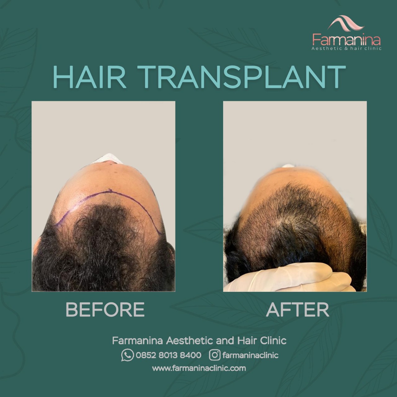 Prosedur Transplantasi Rambut Dan Persiapan Yang Diperlukan