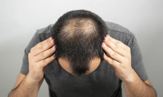 Mengenal Hair Loss Awareness Pada Bulan Agustus