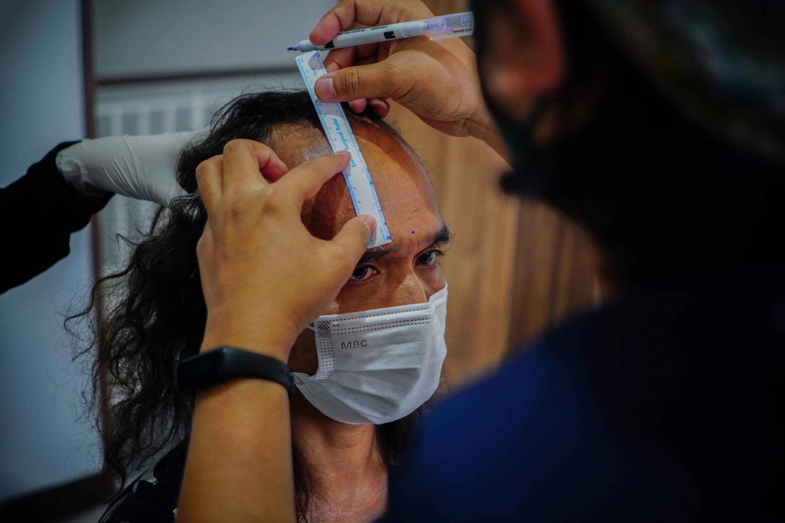 Kaka slank transplasi rambut