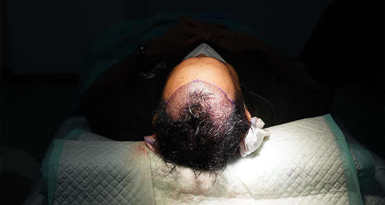 Rambut Caesar Gunawan Kebotakan