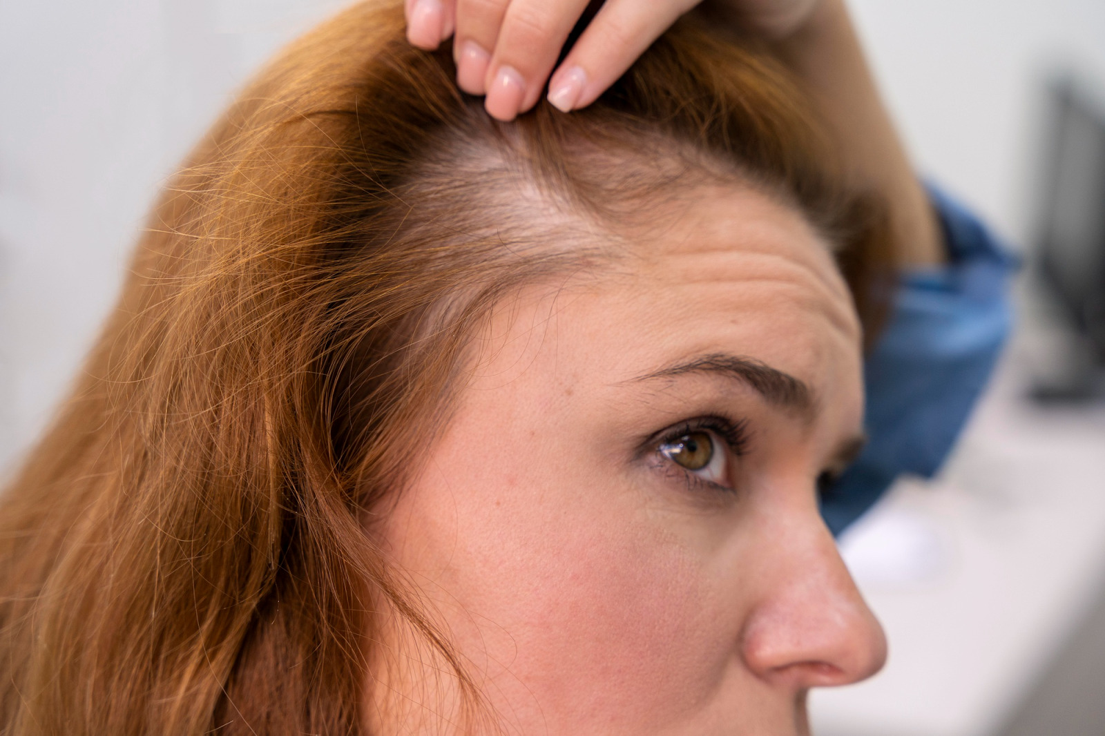 cara mengatasi rambut tipis dan rontok