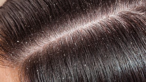 Menelusuri Penyebab Ketombe yang Perlu Anda Ketahui