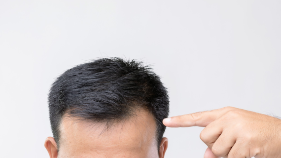 Transplantasi Rambut Bertahan Berapa Lama? Cari Tahu di Sini!