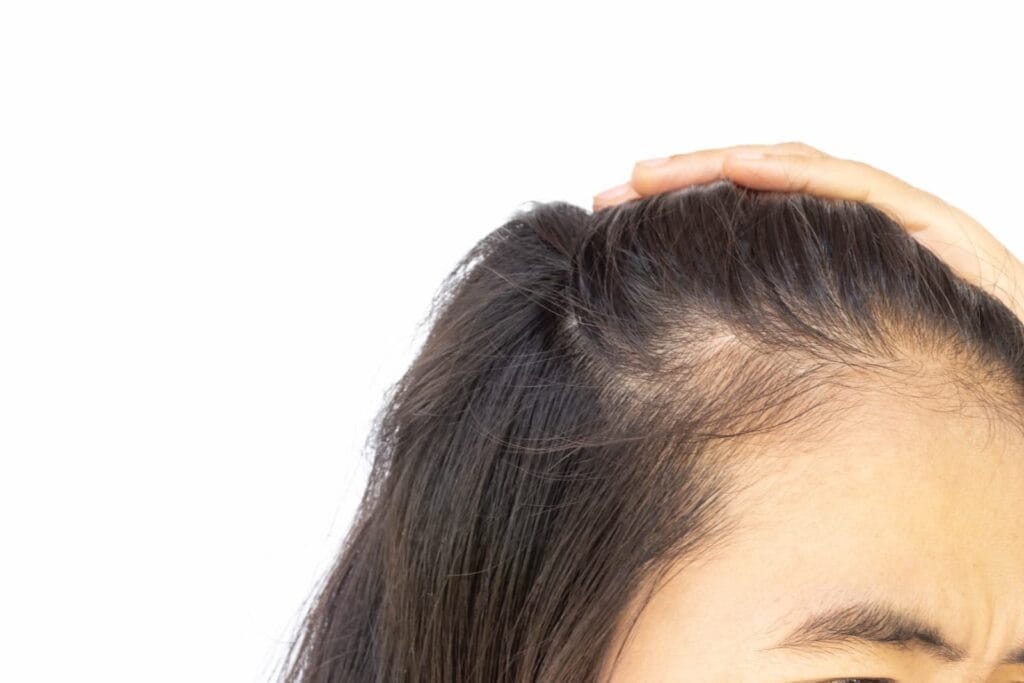 penyebab rambut tipis