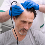 Tips Perawatan Rambut Pasca Hair Transplant