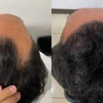 Hasil Tanam Rambut: Solusi untuk Rambut Lebih Tebal