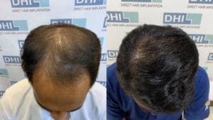 treatment rambut botak