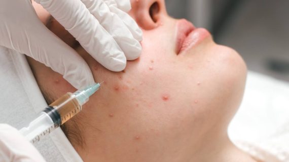 Apa Itu Acne Injection dan Cara Kerjanya untuk Atasi Jerawat