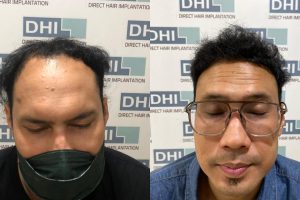 Before After Hair Transplant: Perubahan yang Dapat Diharapkan