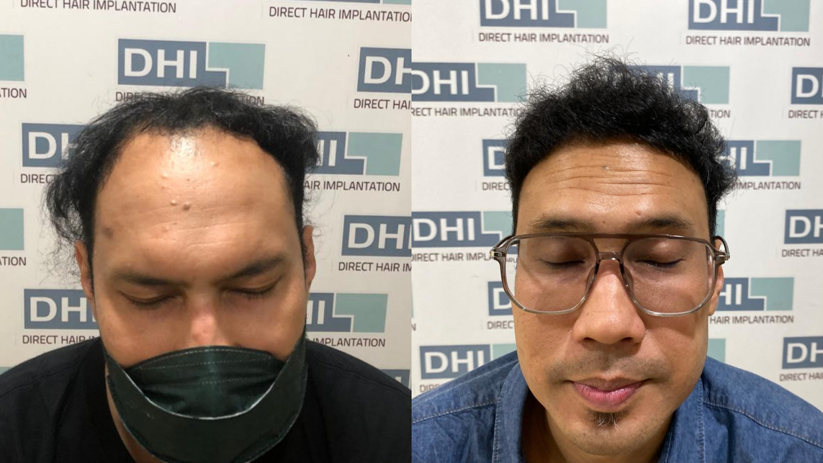 before after hair transplant