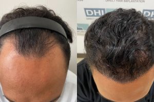Perawatan Pasca Tanam Rambut: Panduan Lengkap dari Hari Pertama hingga 18 Bulan