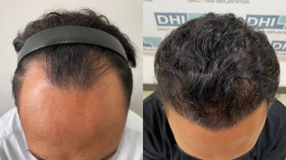 Perawatan Pasca Tanam Rambut: Panduan Lengkap dari Hari Pertama hingga 18 Bulan