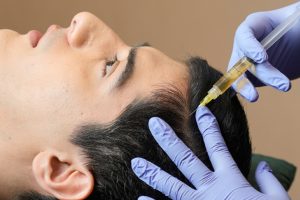 PRP Treatment: Solusi Perawatan untuk Kulit Kepala dan Rambut Sehat