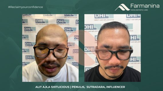 Transplantasi Rambut Artis: Rahasia Penampilan Baru Para Selebriti