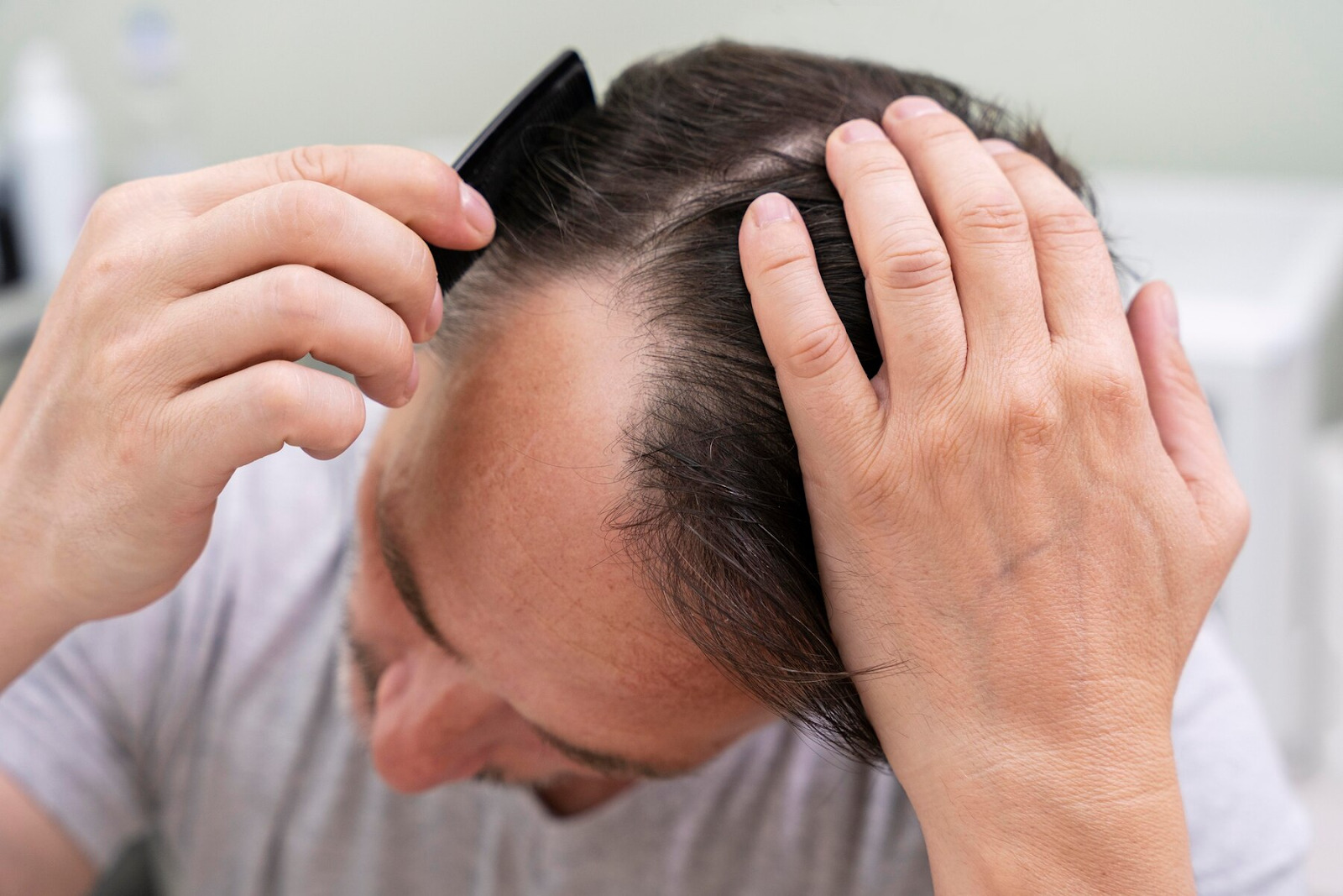 garis rambut mundur pria