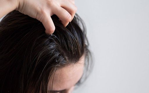 Solusi Rambut Berminyak & Ketombe Parah? Ini Rutinitas Perawatan yang Wajib Dicoba