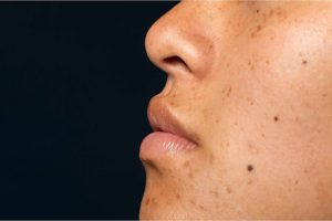 Flek Hitam di Wajah: Beda Melasma, PIH, dan Sun Spot