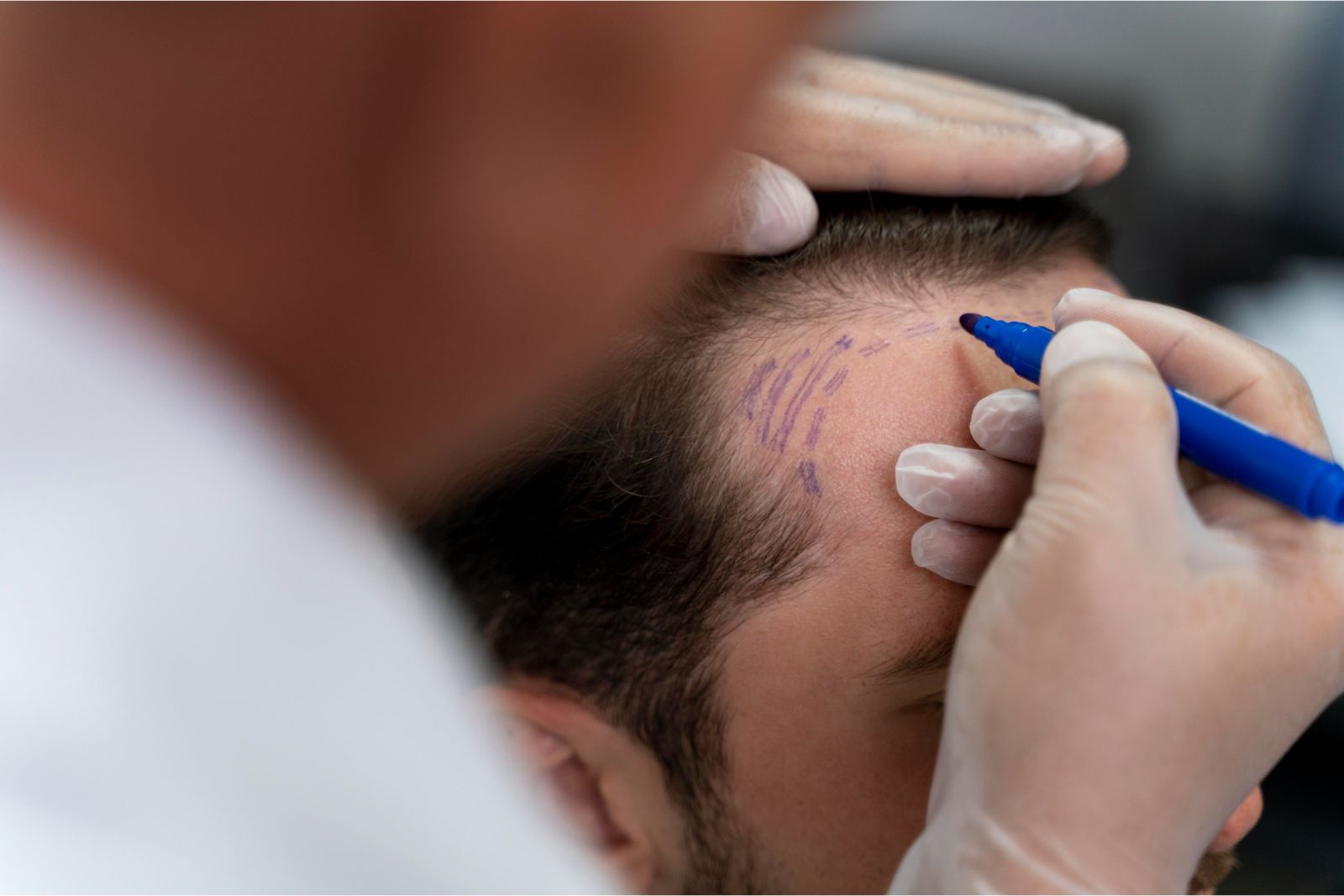 berapa lama proses tanam rambut