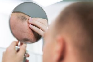 Panduan Memilih Klinik Transplantasi Rambut Terbaik agar Anda Tidak Rugi
